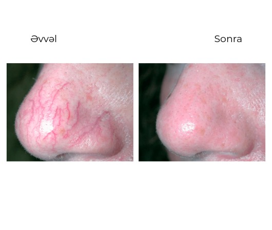 Candela GentleMax Pro Plus